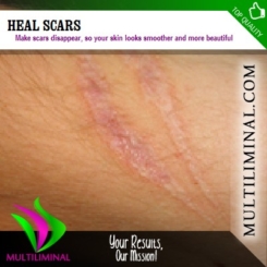 Heal Scars