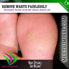 Remove Warts Painlessly